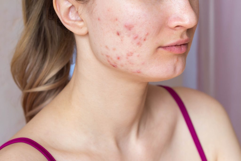 Zeg acne vaarwel dankzij huidvriendelijke probiotica